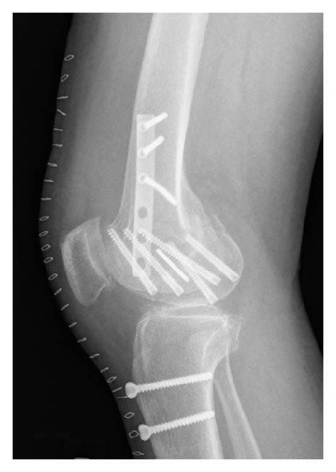 Anteroposterior A And Lateral B Radiographs Obtained Right After