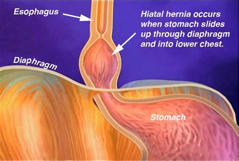 Is A Small Hiatal Hernia Dangerous At Cheryl Talley Blog