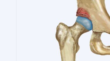 Pinzamiento Femoroacetabular Fai Diagn Stico Y Tratamiento