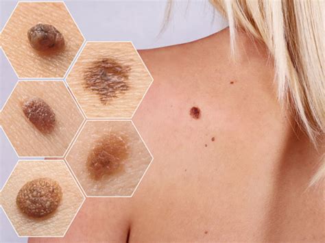 Skin Cancer Doctor In Faridabad Delhi Ncr Dr Arun Pandey