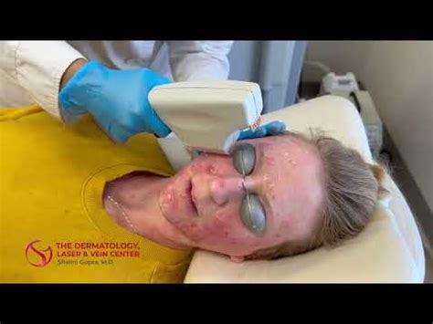 Levulan Photodynamic Therapy For Acne With Blue Light And Laser Dr