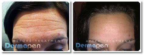 Micro Needling Dermapen Rejuvenations Spa Cambridge