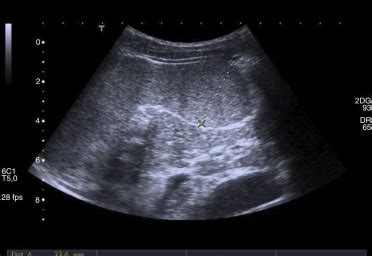 Abdominal ultrasound which shows splenomegaly of 11cm with focal lesion... | Download Scientific ...