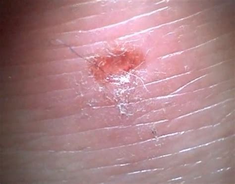 Morgellons Disease Pictures Symptoms Causes Treatment