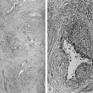 Two More Cases Of Idiopathic Granulomatous Mastitis A Displaying A