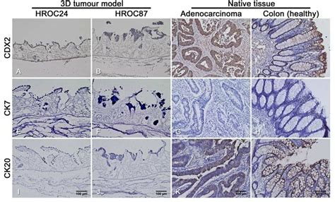 17 Immunohistochemical DAB Staining For The Colorectal Carcinoma