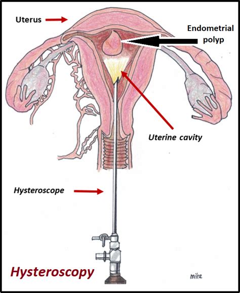 Endometrial Polyps Womens Health By Dr Lee Say Fatt