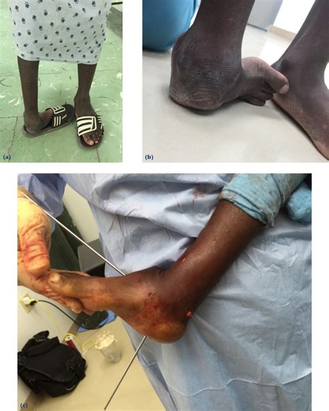 Treatment Of Relapsed Residual And Neglected Clubfoot Adjunctive