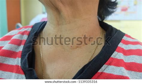 Anterior Neck Swelling Left Thyroid Lobe Stock Photo (Edit Now) 1139335316