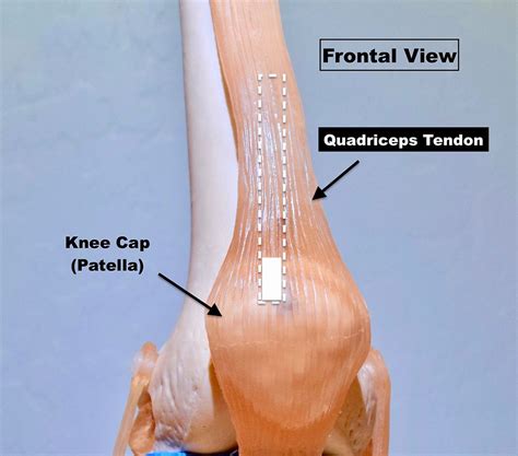 Essentials Of Choosing An Acl Graft