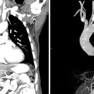 Neck Computed Tomography Angiogram Showed An Irregular Contrast Filling