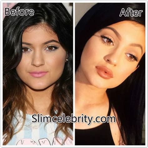 Kylie Jenner Lips0 Kylie Jenner Lip Injections Kylie Jenner Lips Lip Plastic Surgery