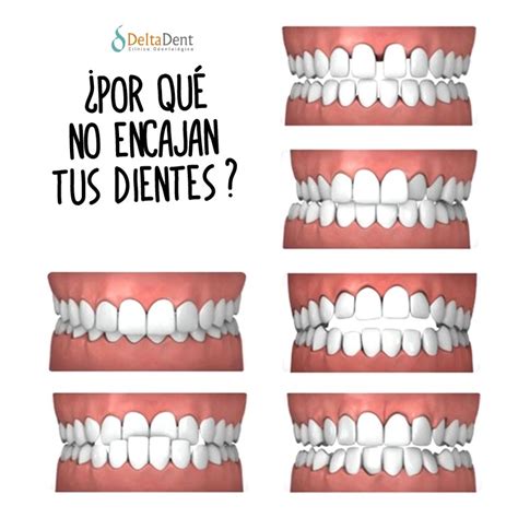 Maloclusión dental por qué no encajan tus dientes CLÍNICA DENTAL