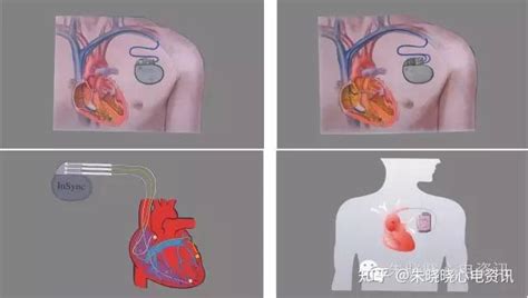 心脏起搏器基础知识 知乎