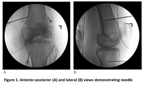 How I Do It Genicular Nerve Radiofrequency Ablation