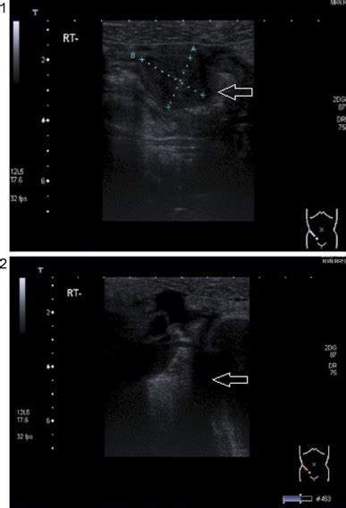 1 Ultrasound Of Right Iliac Fossa Showing A Tubular Structure Download Scientific Diagram