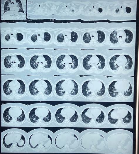 High‐resolution Computed Tomography Hrct Of The Case Download