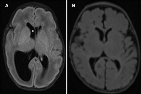 Frontiers Case Report Occlusion Of The Foramen Of Monro Treated With Endoscopic Septostomy