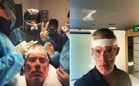 Story Behind Joe Buck's 9 Hair Transplants | Longevita