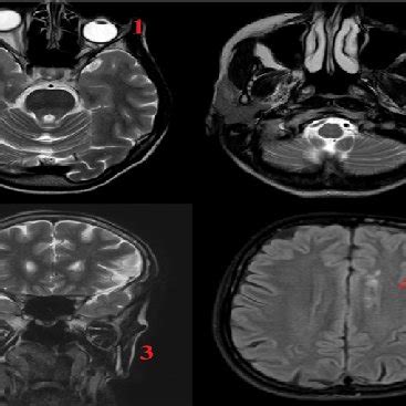 Brain MRI of the 43-years old female patient with Parry-Romberg... | Download Scientific Diagram