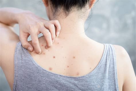 How To Get Rid Of Back Acne Best Bacne Treatments For Body Breakouts Uk