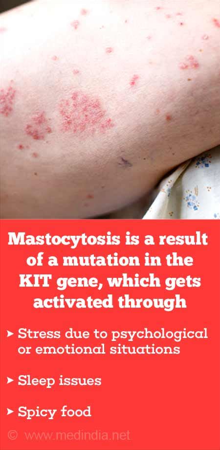 Systemic Mastocytosis Triggers