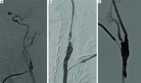 Intraoperative Angiography Intraoperative Angiography Of The Carotid Download Scientific