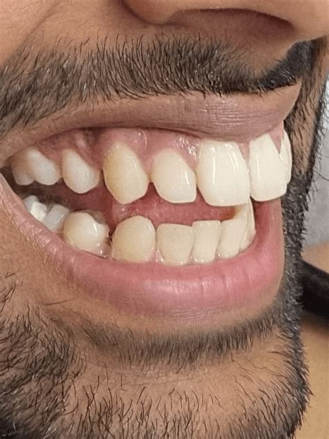 Overjet Overbite Even After 2 Years Of Treatment R Invisalign