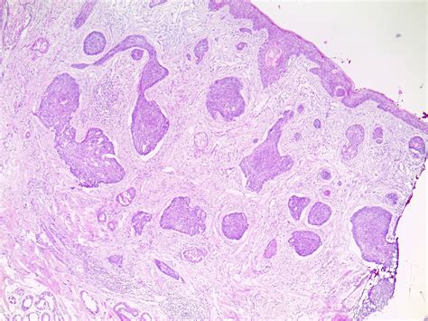 Basal Cell Carcinoma: The Definitive Guide - Skintel