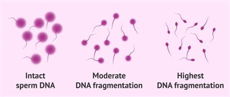 Sperm Dna Fragmentation Causes And Effect On Fertility