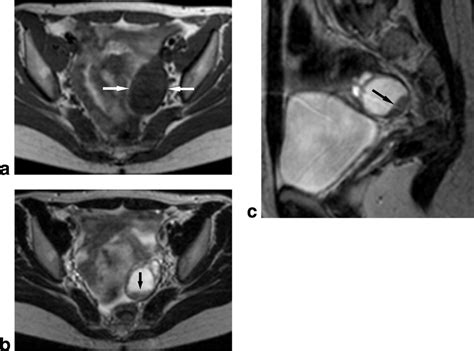 Hemorrhagic Ovarian Cyst Mri