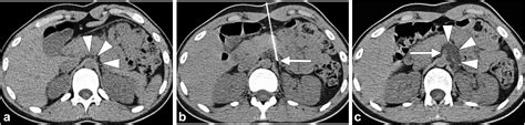 Ct Guided Celiac Ganglion Block For Neurogenic Gastrointestinal