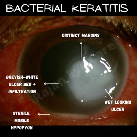 Signs of Bacterial Keratitis!