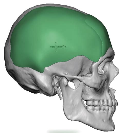 Plastic Surgery Case Study Custom Mastoid Skull Implants After Large