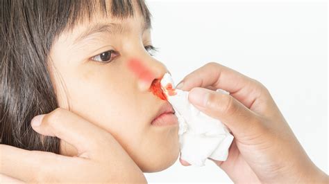 Nosebleeds In Children What Causes Them And How To Handle Them At