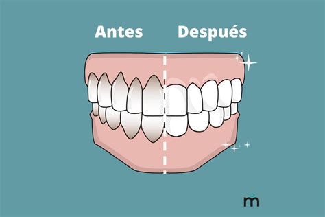 La Retracci N De Enc As Causas Consecuencias Y Soluciones