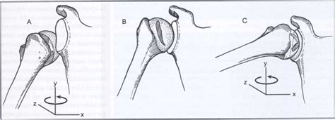 The Nonengaging Hill Sachs Lesion A This Impaction Fracture Is Download Scientific Diagram