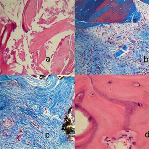 Particulate allograft (6 months). a, b) Fragments of bone graft... | Download Scientific Diagram