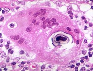 Schaumann bodies - Libre Pathology