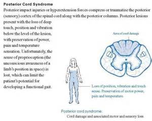 Posterior Cord Syndrome Spinal Cord Syndromes Emergency Medicine