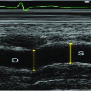 Measurements Of Systolic S And Diastolic D Diameters Of The