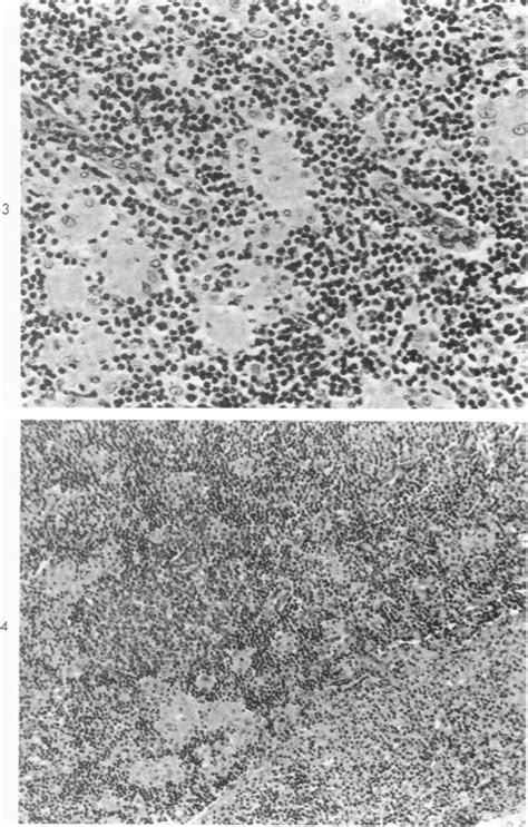 Figure 3 From The Posterior Cervical Lymph Node In Toxoplasmosis