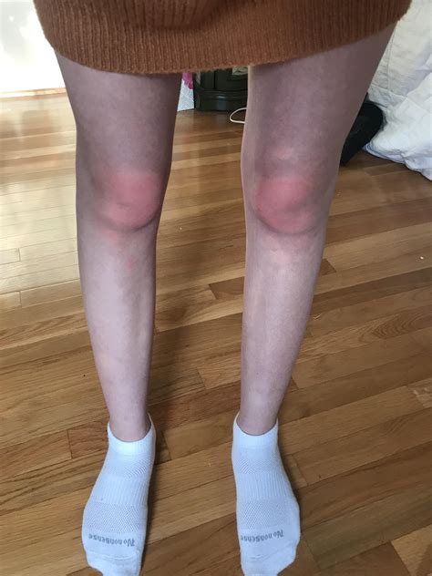 Knees Are Extremely Red Hot Swollen And Throbbing Suddenly What Is Going On Ehlersdanlos