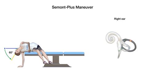 Semont Plus Maneuver For Right Posterior Canal Benign Paroxysmal