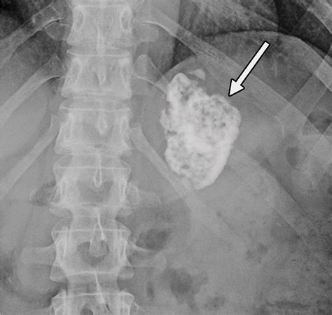 Diagnostic Approach To Benign And Malignant Calcifications In The Abdomen And Pelvis Radiographics