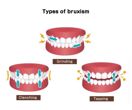 Michigan and Tanner splint for TMJ and Bruxism pain