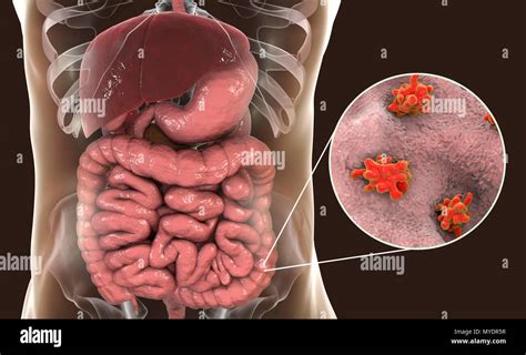 Parasitic Amoeba Entamoeba Histolytica In The Large Intestine Computer Illustration This