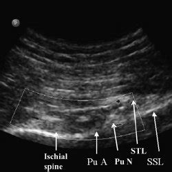 Pdf Randomized Controlled Trial Comparing Pudendal Nerve Block Under