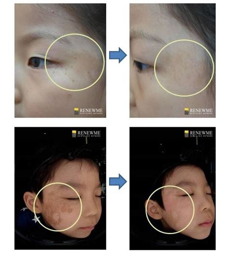 Renewme Skin Clinic: Birthmark, Café-Au-Lait Spot removal Laser treatment