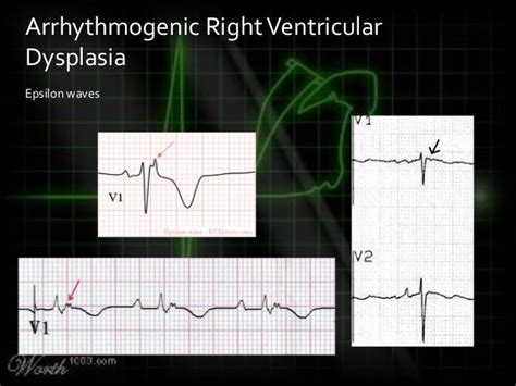 Killer Ecgs